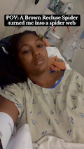 "The culprit..A Brown Recluse Spider bit me.. Had me looking like a web & shedding like a snake 😫 literally my entire body shedded from head to toe, back & stomach" thumbnail